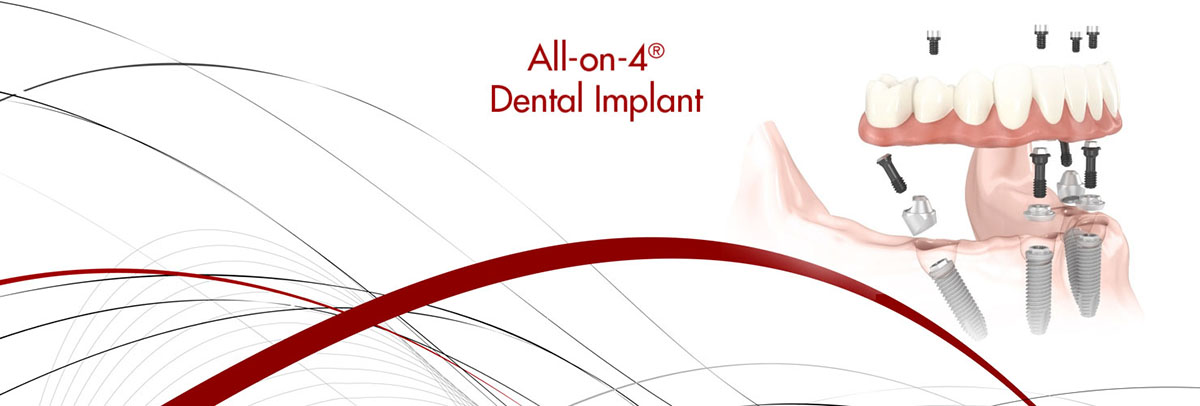 Rockville All-on-4 Dental Implants