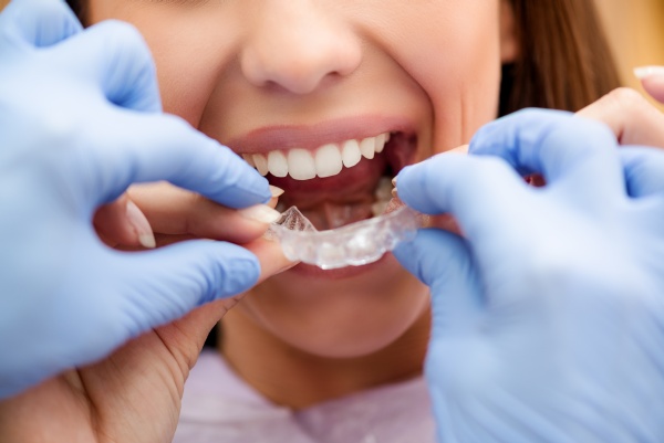 Clear Braces: What Are They?