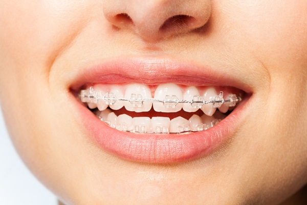 How Long Does Treatment With Clear Braces Normally Take?
