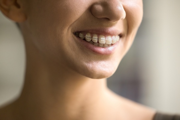 Proper Care For Clear Braces
