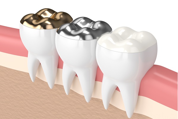 What Happens During A Dental Filling Procedure?