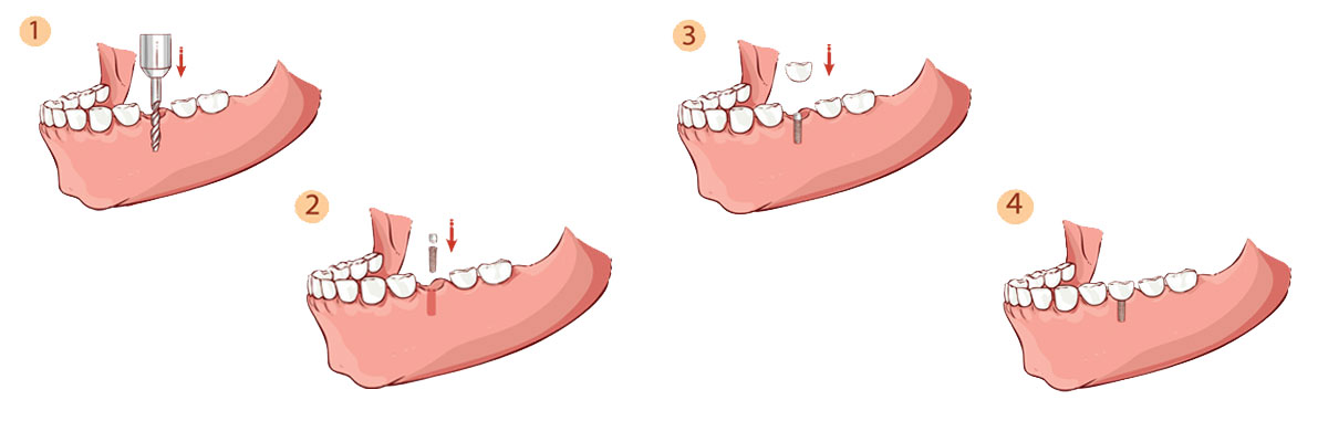 Rockville The Dental Implant Procedure