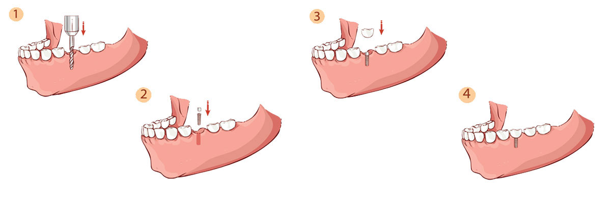 Rockville Dental Implant Restoration