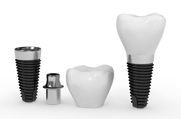 How Does The Jawbone Affect The Ability To Get Dental Implants?