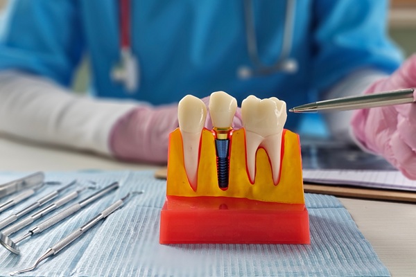A Dental Implant And Crown For A Single Missing Tooth