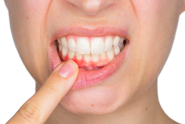 Why Gum Disease Prevention Is So Important