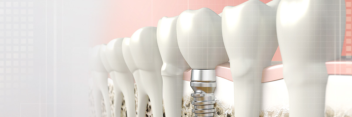 Rockville Implant Dentist