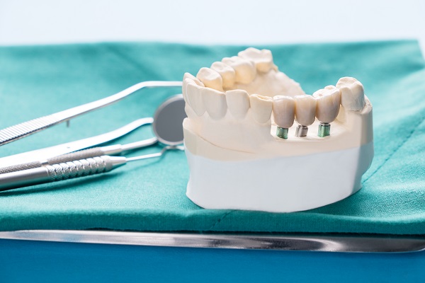 Implant Supported Dentures Rockville, MD