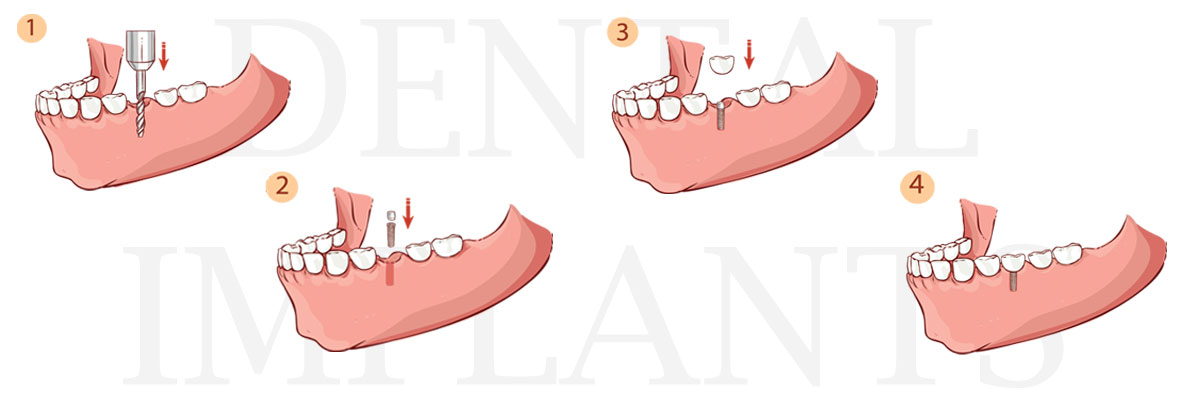 Rockville The Difference Between Dental Implants and Mini Dental Implants