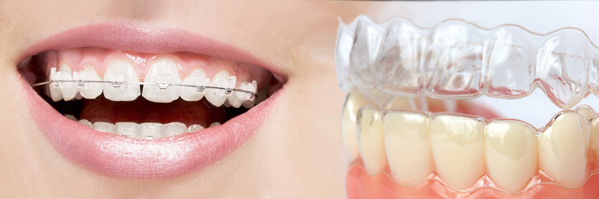 Rockville Which is Better Invisalign or Braces