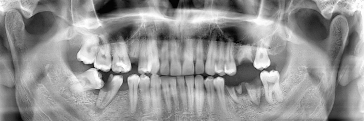 Rockville Wisdom Teeth Extraction